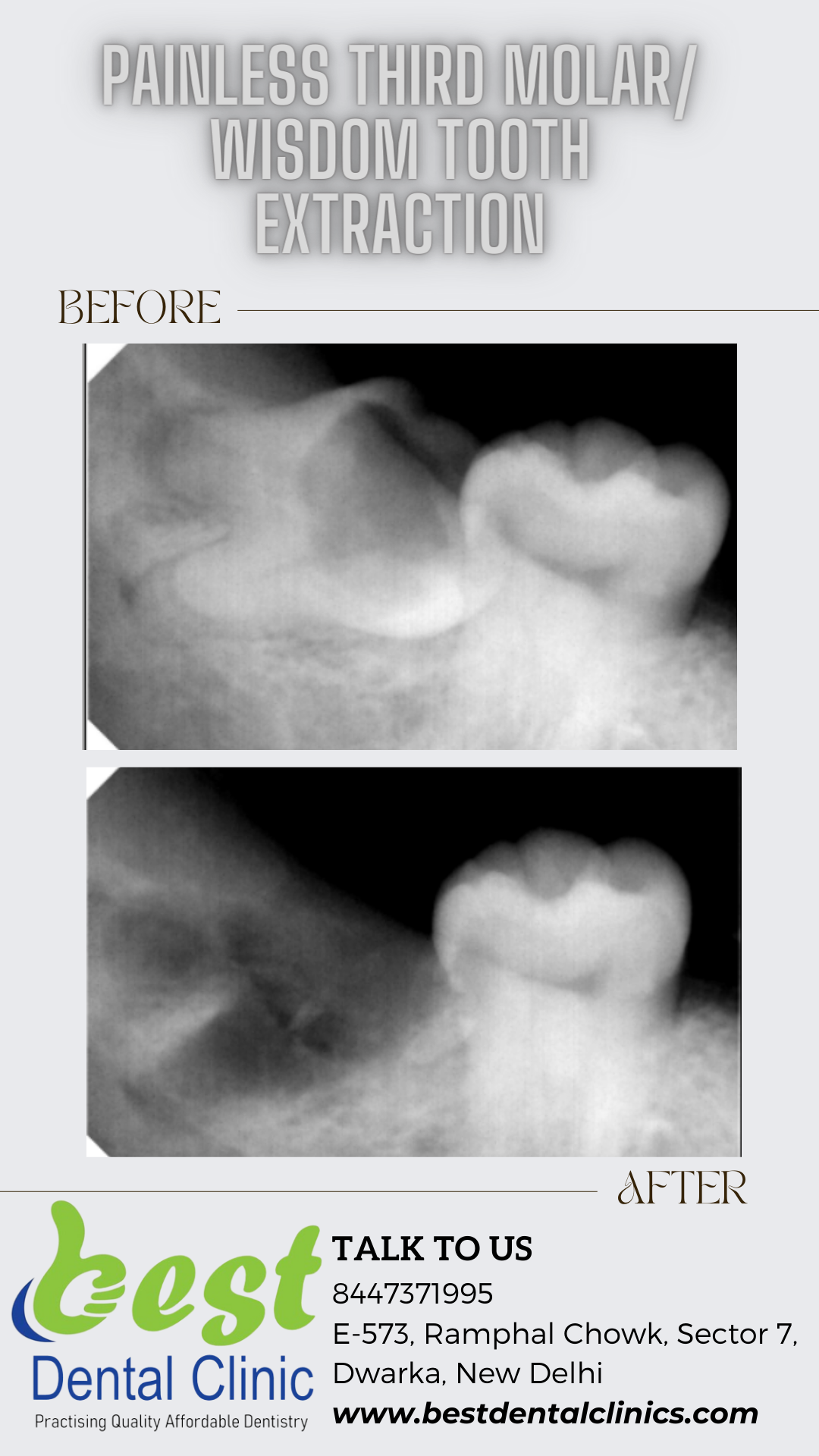 Painless Third molar/Wisdom Tooth Removal